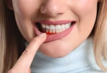 Ka daryti jeigu kraujuoja dantenos