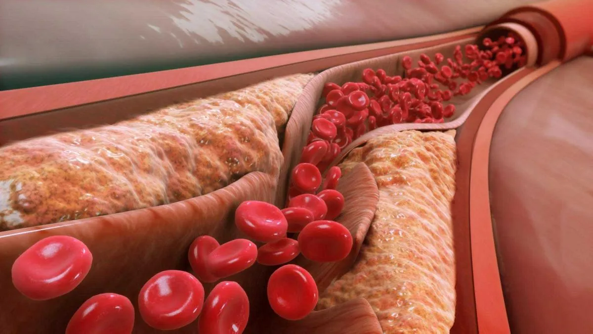 Didelis cholesterolio kiekis