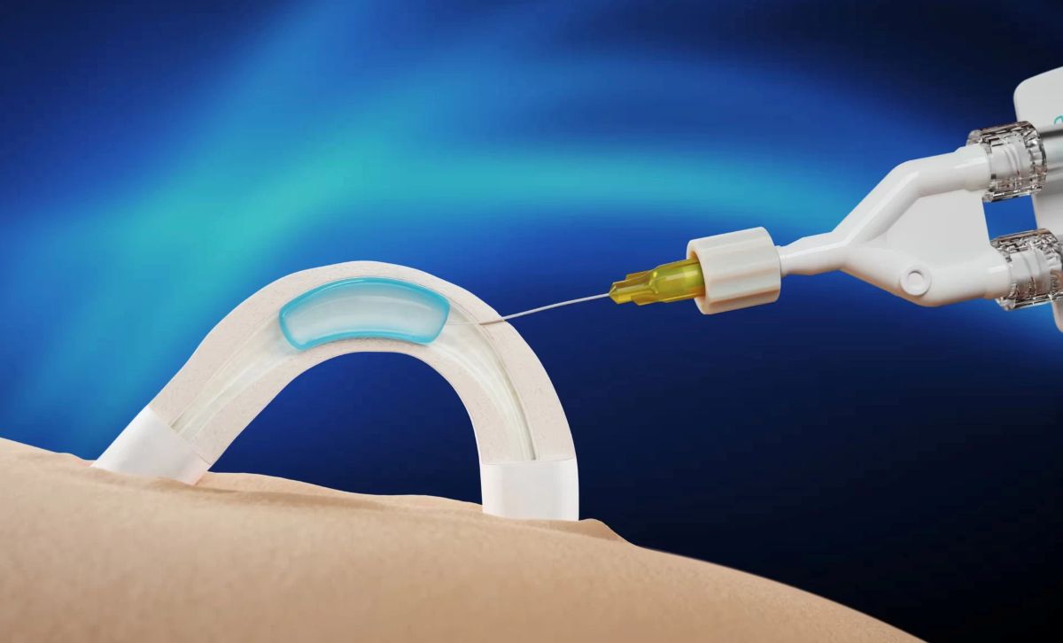 Specialus implantas vyrams
